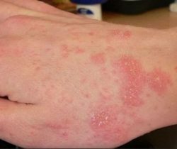 bi-cham-vao-mua-dong-nguy-hiem-nhu-the-nao