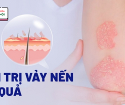 cach-dieu-tri-vay-nen