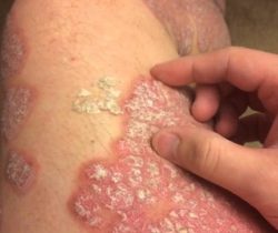 cach-dieu-tri-benh-vay-nen-tai-nha-co-hieu-qua-khong