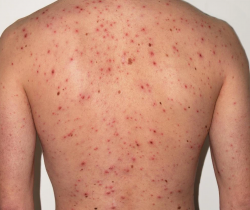 mun-trung-ca-o-lung-nguyen-nhan-va-cach-khac-phuc-hieu-qua