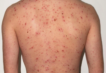 mun-trung-ca-o-lung-nguyen-nhan-va-cach-khac-phuc-hieu-qua