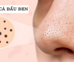 tri-mun-trung-ca-dau-den