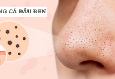 tri-mun-trung-ca-dau-den